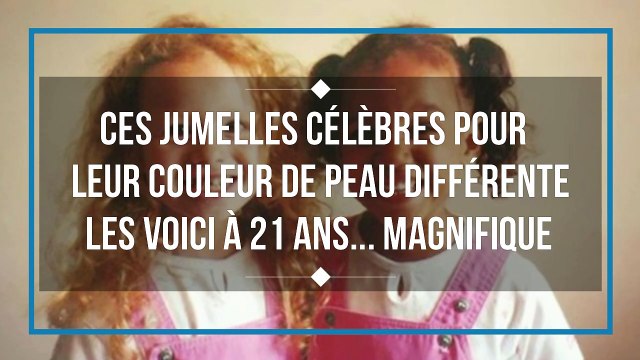 Ces jumelles sont célèbres pour leur couleur de peau différente. les voici à 21 ans...