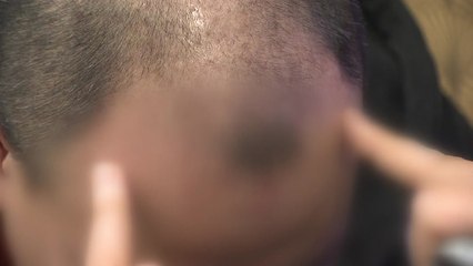 겨울철 '탈모' 예방하려면 귤 드세요! / YTN