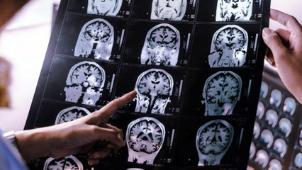 Brain Swelling Drugs May Help Alzheimer’s, Too