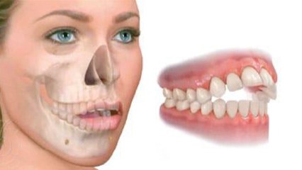 bd-problemas-comunes-en-mordida-111219