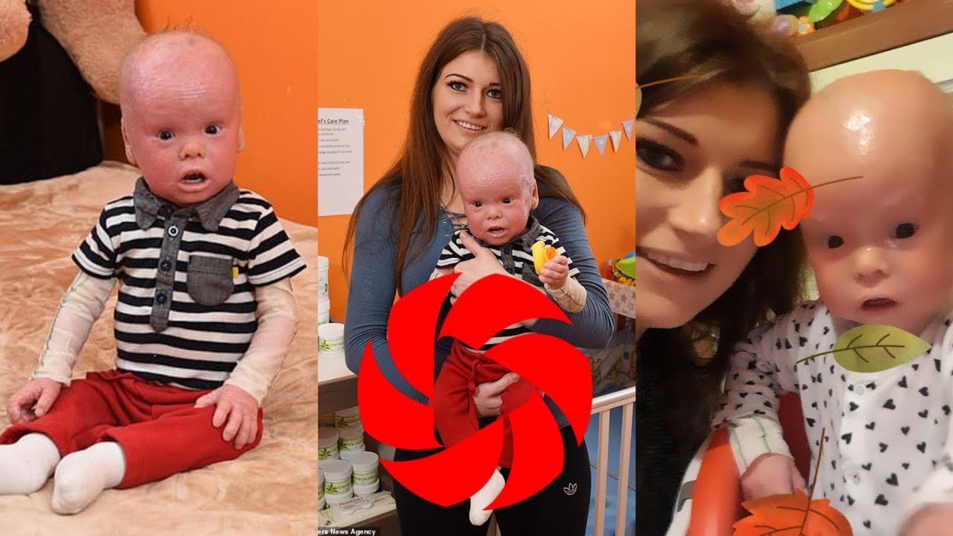 Le Plus Rapide Syndrome Du Bebe Arlequin