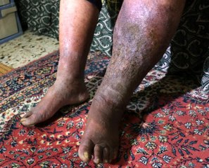 Varis ameliyatı oldu, fil hastası çıktı: Hayatım mahvoldu