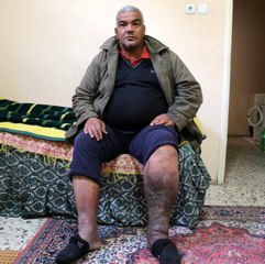 Varis ameliyatı oldu, fil hastası çıktı