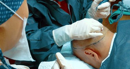 Saç ekiminde "Seyyar ekimciler" ortaya çıktı