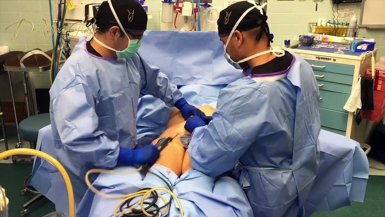 When can I exercices after lipo