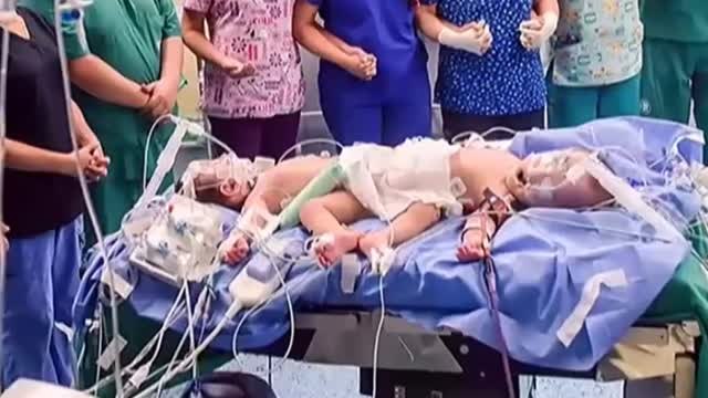 Separan con éxito en Perú a unos siameses