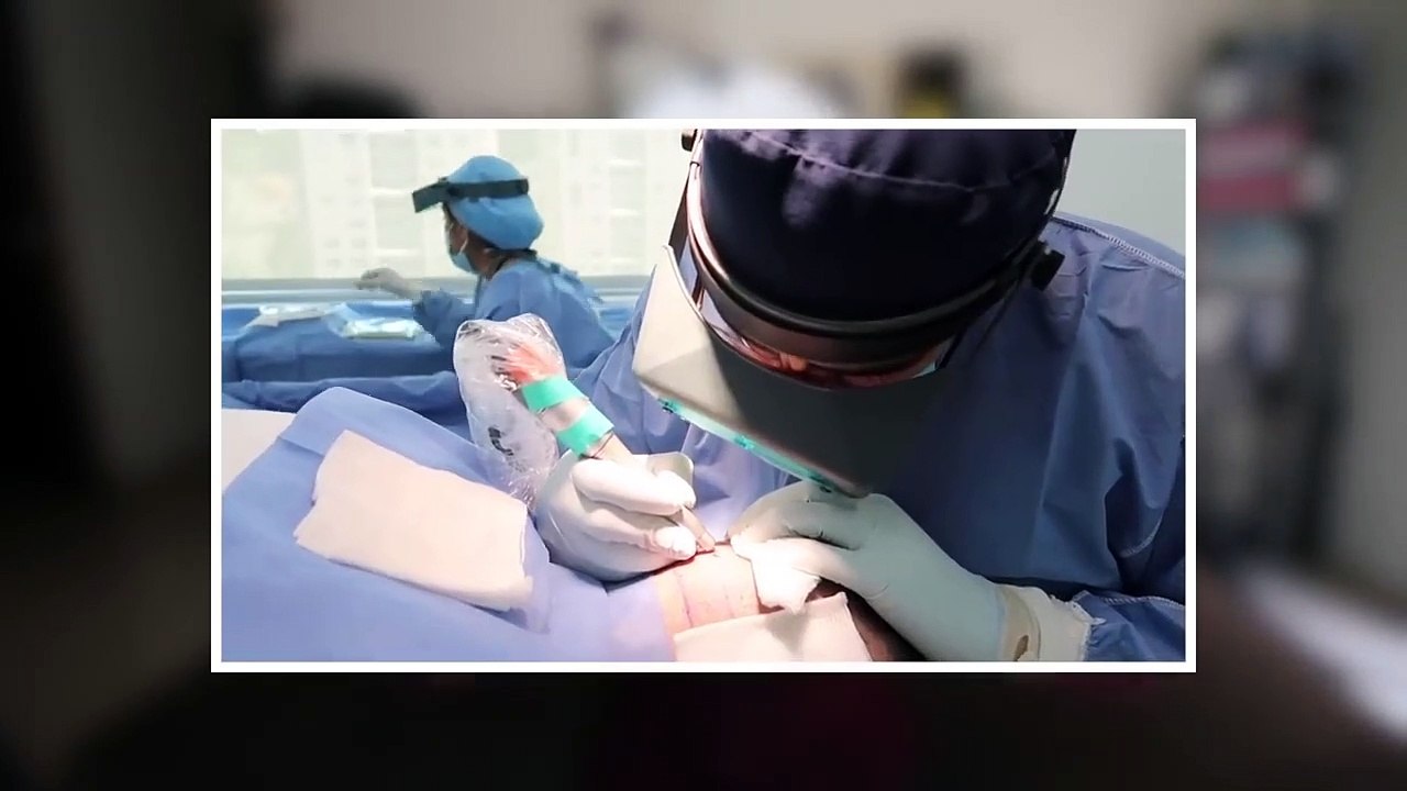 HOW MUCH DOES A HAIR GRAFT COST? - Beto Pasillas 