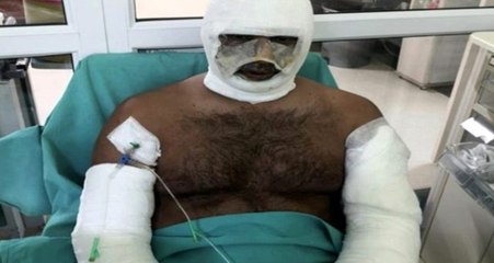 Kebapçıda fırın patladı, iş yeri sahibi ağır yaralandı