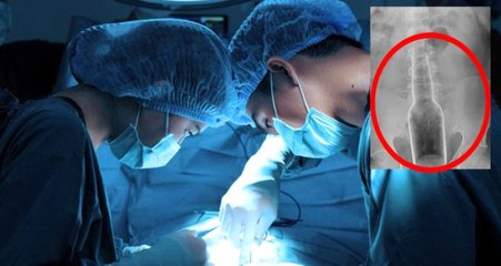 Doktorlar bile şaşırdı! Hastanın anüsünden 18 santimetre uzunluğunda, 5 santimetre kalınlığında şişe çıkarıldı