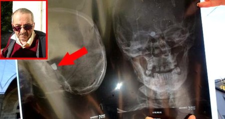47 yıldır başındaki maganda kurşunuyla yaşayan talihsiz adam: Artık bu acıya katlanamıyorum