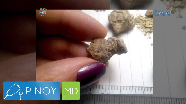 Pinoy MD: Kidney stones, paano ba masosolusyonan?