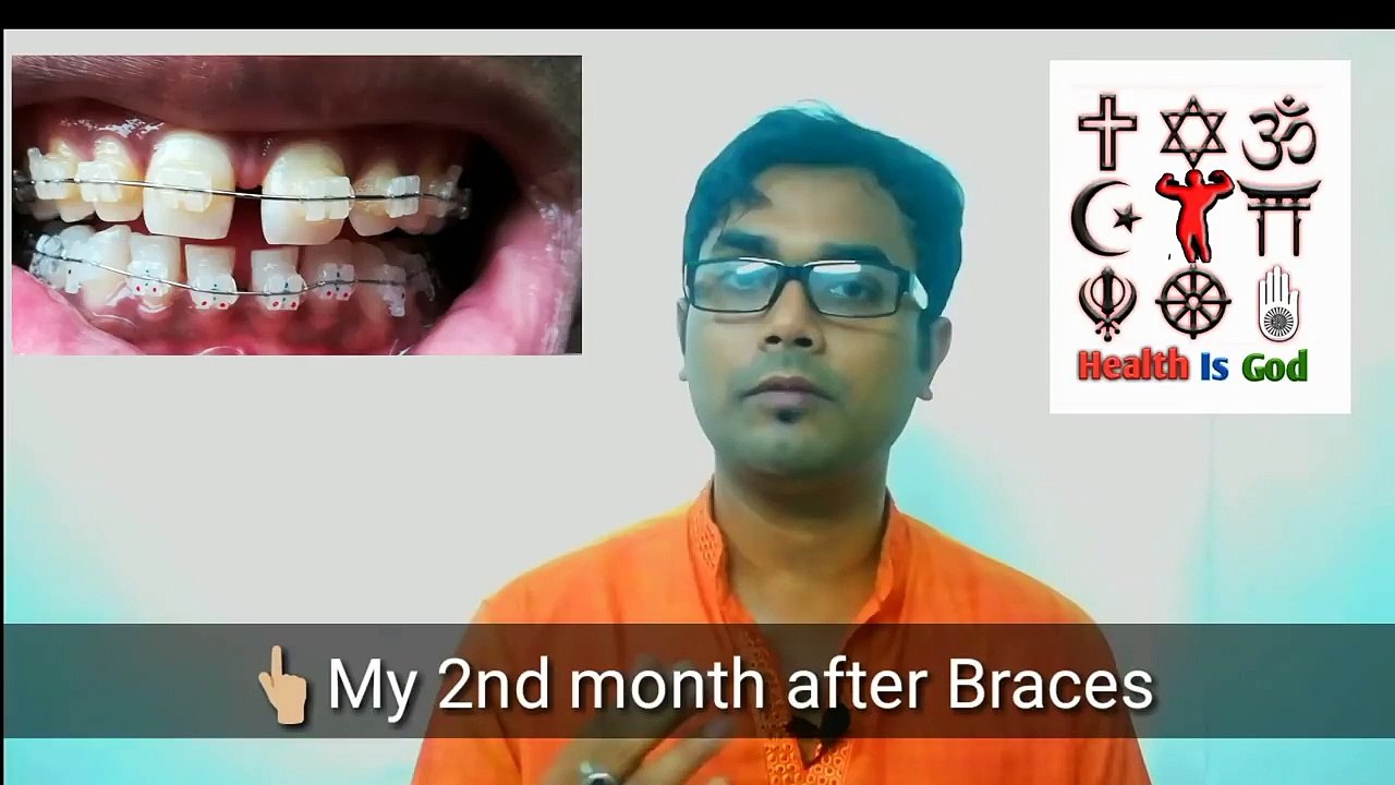 TYPES AND COST OF BRACES(HINDI) video Dailymotion
