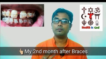 TYPES AND COST OF BRACES(HINDI)
