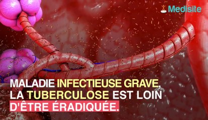 Un cas de Tuberculose signalé dans le Pas-de-Calais