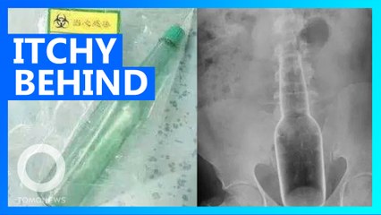 Man jams 18-cm long bottle into his behind to scratch an itch