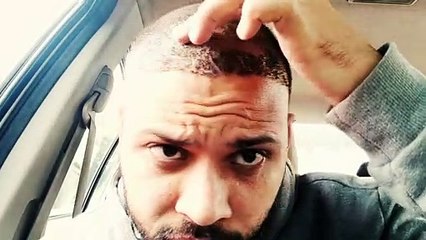 Amazing Hair Transplant Results After Just 1 Week! 🌟