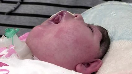 Anensefali hastası bebek azmiyle doktorları bile şaşırtıyor (2)