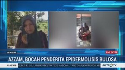 Perjuangan Azzam Lawan Sakit Epidermolisis Bulosa