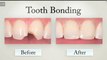 Natoli Dental: JOSEPH N. NATOLI, DMD Cosmetic Dentist Explains Procedures