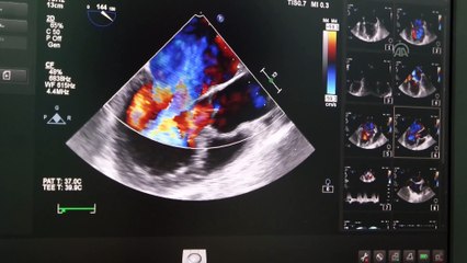 Kalp enfeksiyonu hastalarına 'beslenme bozukluğu' uyarısı - BURSA