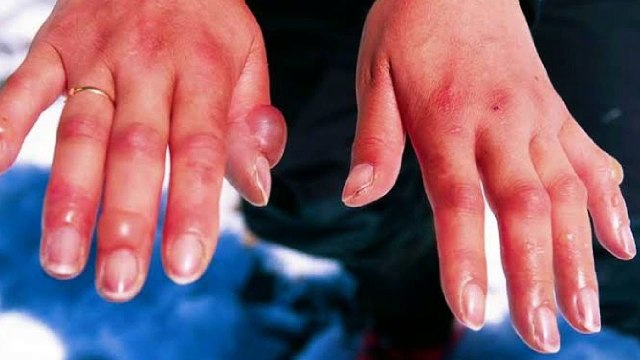 ठंड से हाथ - पैरों की उंगलीयों में सूजन और खुजली का घरेलू इलाज Home remedies for chilblains | amazing tips for the swelling of fingers winter season in hindi | feet and hand swelling in winters | Health tips | Home remedies | chilbchilblains | घरेलू इलाज