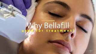 What is the Specialty of Bellafill Treatment in Las Vegas