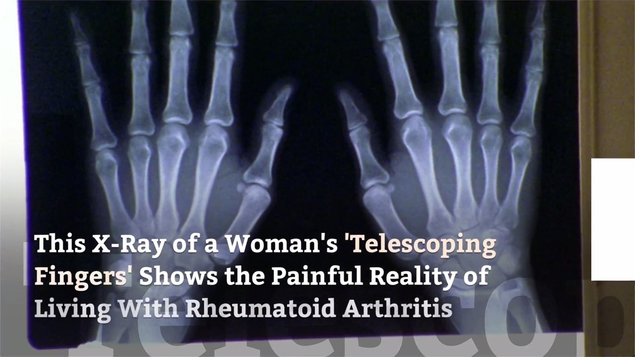 This X-Ray of a Woman's 'Telescoping Fingers' Shows the Painful Reality of Living With Rheumatoid Arthritis