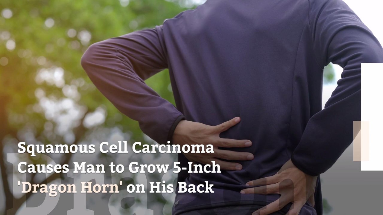 Squamous Cell Carcinoma Causes Man to Grow 5-Inch 'Dragon Horn' on His Back