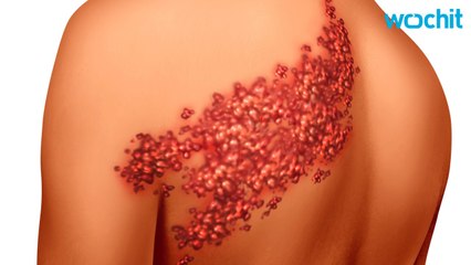 Study: Patients With Cancer Diagnosis Need To Watch Out For Shingles Virus
