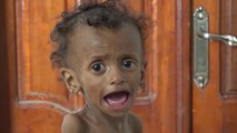 الأمم المتحدة: مليونا طفل باليمن يعانون سوء التغذية
