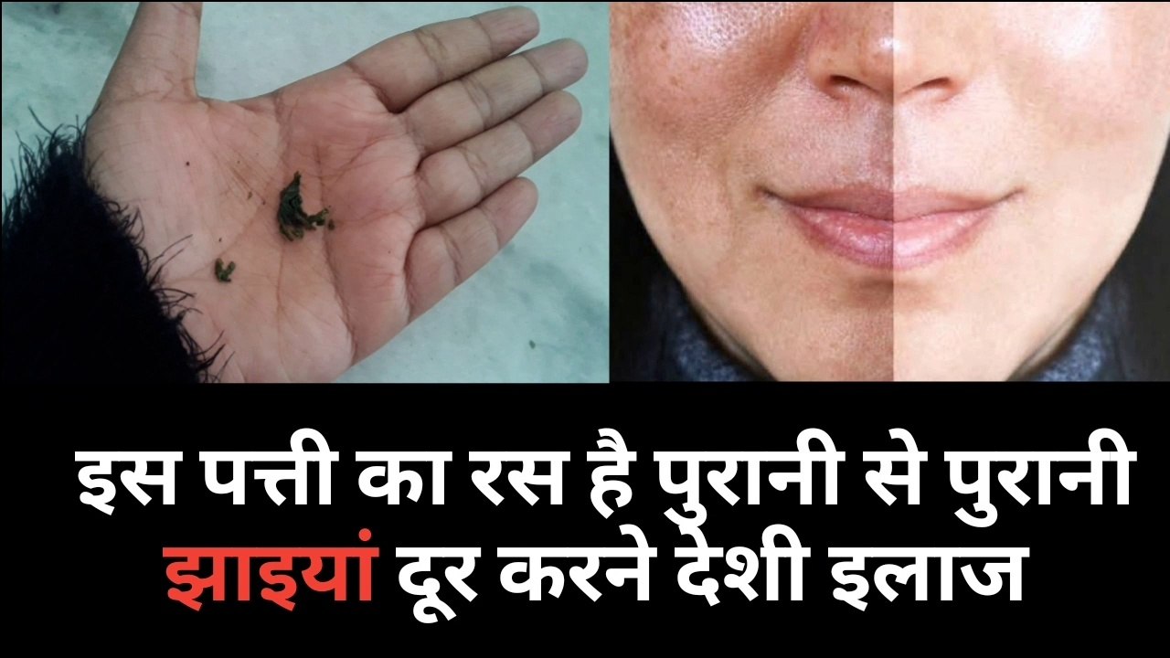 झाइयां दूर करने  का 100% देशी इलाज | झाइयां हटाने के उपाय | झाई का इलाज | jhaiya khatam krne ka tarika | pigmentation treatment at home | jhaiya hatane ka deshi ilaj Hindi me | Home remedies for jhaiya | jhaiya kaise dur kre | skin care tips| Shruti Gupta