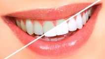 الابتسامة رقميا.. كيف يتم تجميل الأسنان من خلال هذه التقنية؟ - العيادة