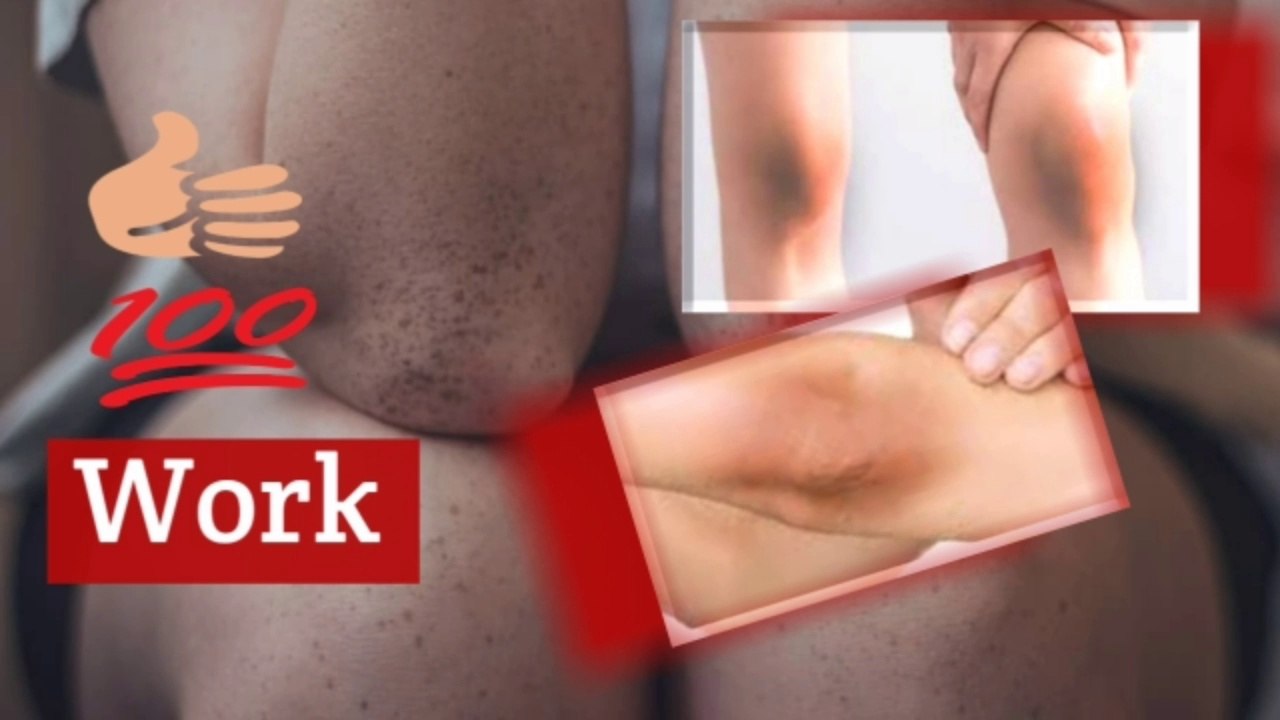 How to Get Rid of Dark Spots on Knees and Elbows Fast | elbows dark spots removal |