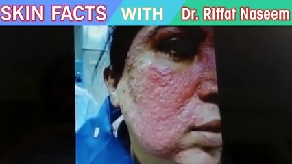 Side effects of whitening creams