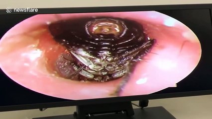 Disturbing video reveals fly burrowing into man's ear with dozens of larvae