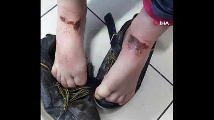 - Okul bahçesinde oynayan öğrencilerin vücutlarında oluşan çürük ve yanıklar sağlık kuruluşları ile Belediyeyi harekete geçirdi