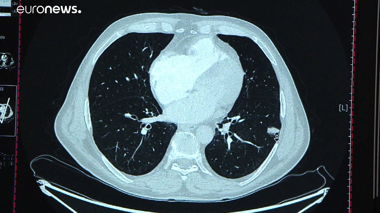 Kampf gegen Lungenkrebs: 500 Leben retten dank Früherkennung