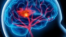 الأعراض الأكثر شيوعا للسكتة الدماغية تعرف عليها و تجنبها