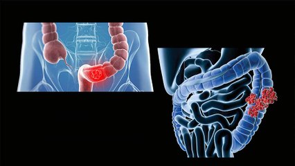 bd-lo-que-debe-saber-de-la-gastroscopia-150120