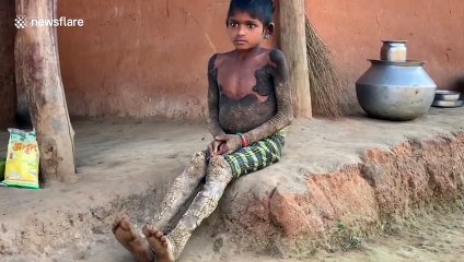 Rare genetic disorder causes girl's skin to turn to 'tree bark' in central India