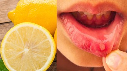 मुंह के छालों Mouth Ulcers का घरेलू उपचार | मुंह के छाले इस नुस्खे से तुरंत ठीक होंगे | Boldsky