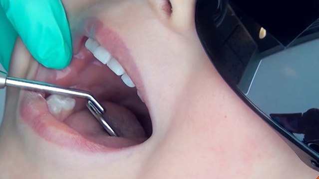 bd-alimentos-que-aumentan-las-caries-170120