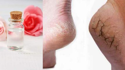 Télécharger la video: फटी एड़ियों का चमत्कारी घरेलु उपाय | Home Remedies To Avoid Torn Heels In winters | Boldsky