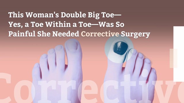 This Woman's Double Big Toe—Yes, a Toe Within a Toe—Was So Painful She Needed Corrective Surgery