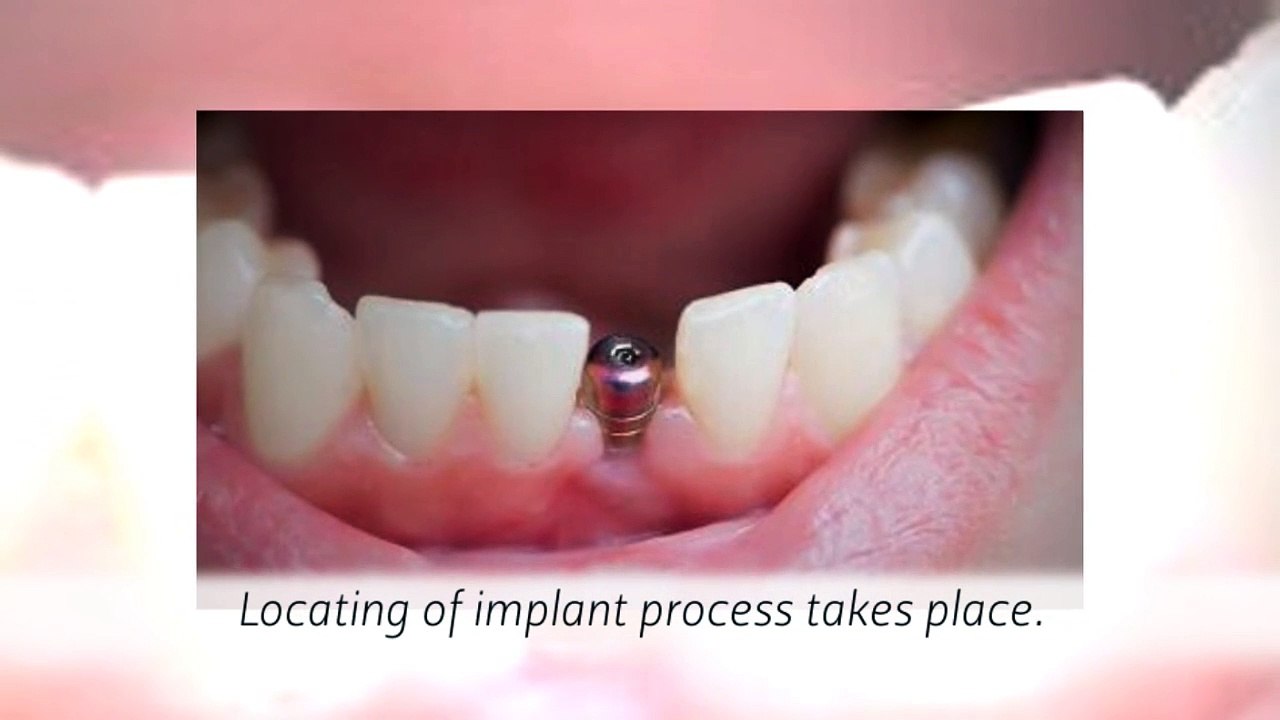 Make your Smile Strong with Dental Implants