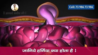 Hernia | Define | Signs | Symptoms | Types | Abdominal | Ayurvedic Treatment | Cure | Tips | Remedies