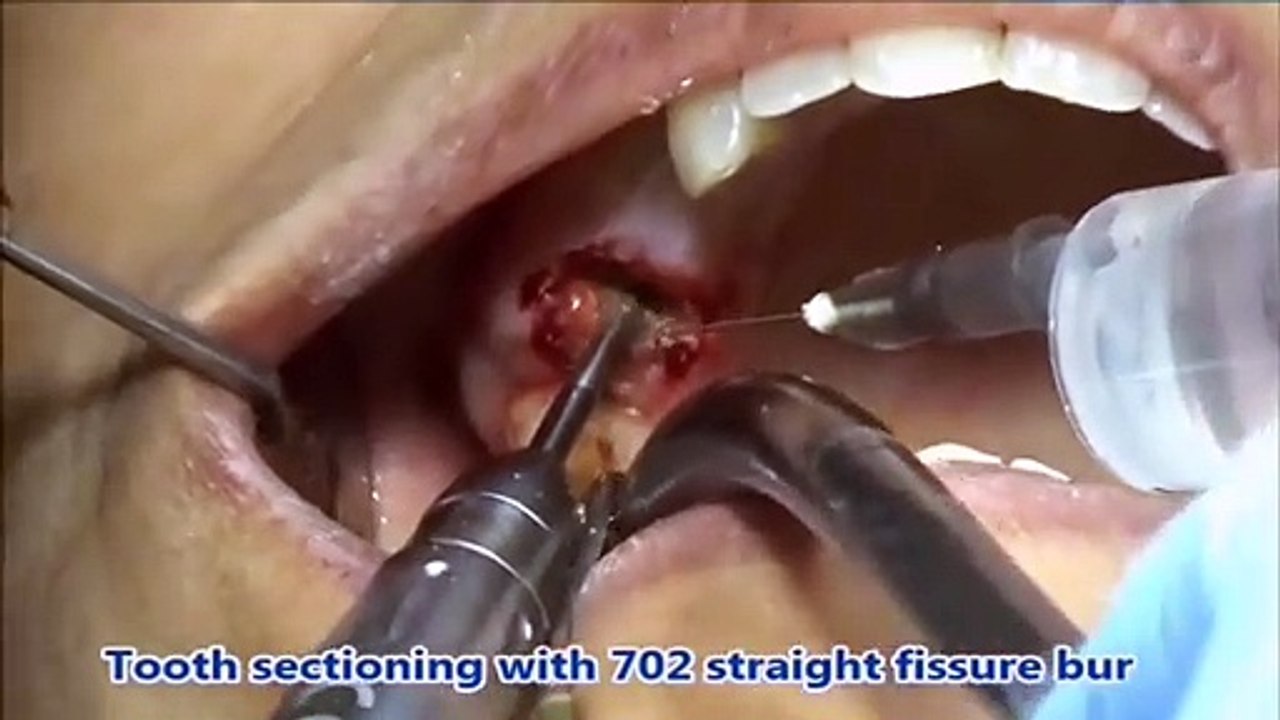 Failed RCT molar tooth Extraction || Upper molar RCT