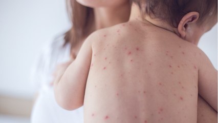 Adults Exposed To Children With Chickenpox Less Likely To Get Shingles