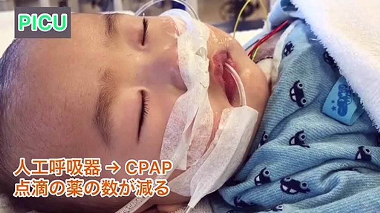 【赤ちゃん】心臓手術後の経過報告① | 心室中隔欠損(VSD) | ICU〜一般病棟