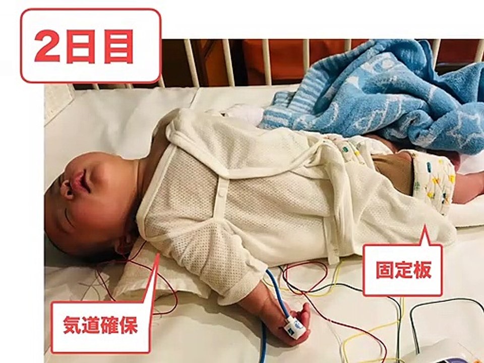 【修正3ヶ月】心臓カテーテル検査入院 - cardiac catheter of japanese baby -